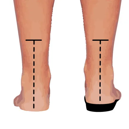 Leg Length Imbalance Correction Near Me in Houston, TX.